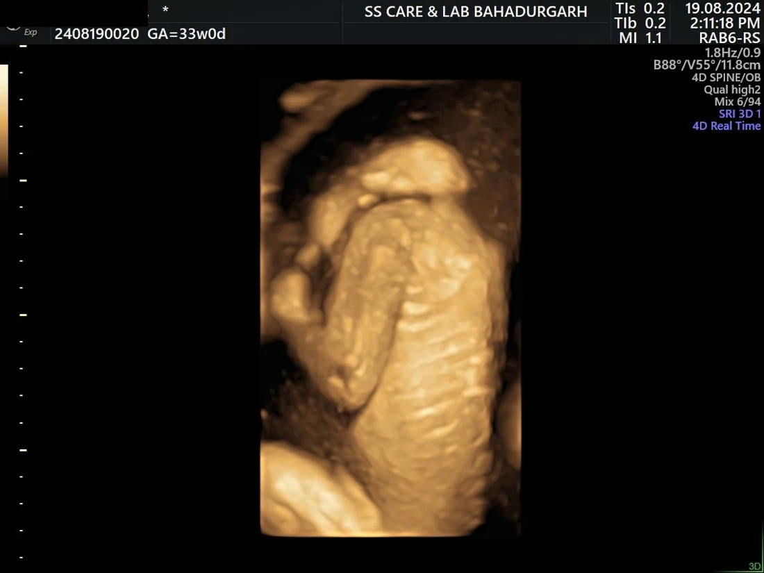 Anencephaly–Exencephaly Spectrum — Antenatal Detection