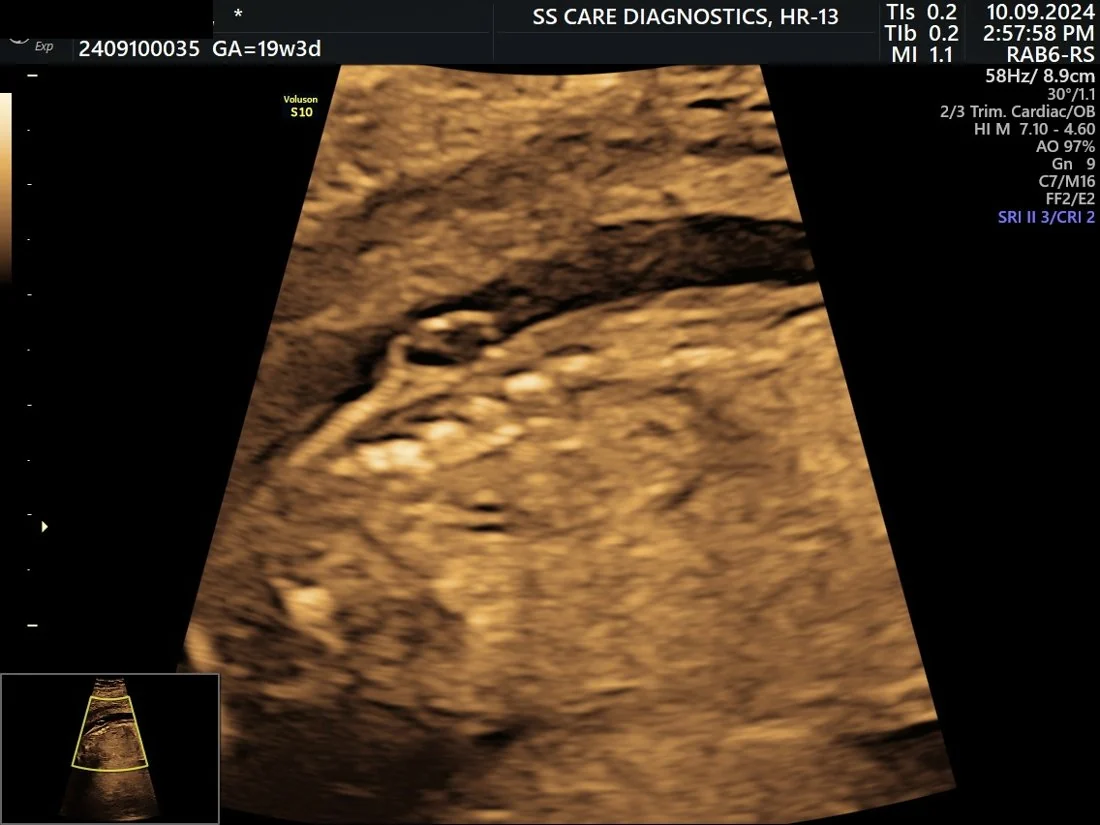 Neural Tube Defect (NTD) — Antenatal Detection